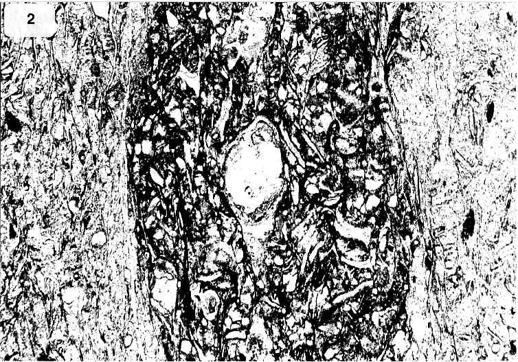 Gesteinsbruchst&uuml;ck mit vitroklastsichen Strukturen